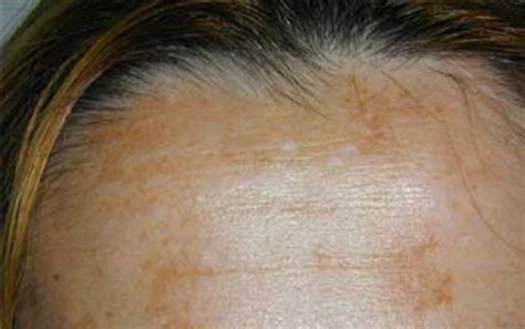 Melasma Del Viso Cause E Come Eliminarlo Vigilasalute