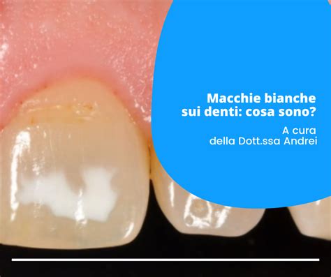 COSA SONO LE MACCHIE BIANCHE SUI DENTI Studio Dentistico Atanor Dr