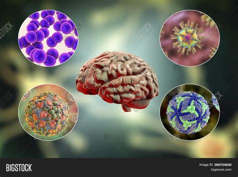 Meningitis Brain Infection