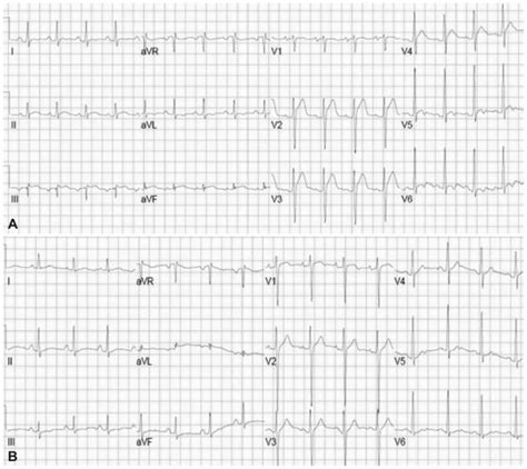 Electrocardiogram in acute pericarditis. Diffuse ST segment elevation ...
