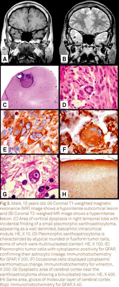 Scielo Brasil Pleomorphic Xanthoastrocytoma Magnetic Resonance