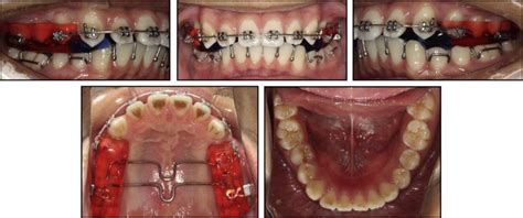 Severe Class Ii Division 1 Malocclusion In An Adolescent Patient Treated With A Novel Sagittal