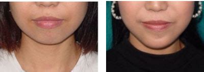 Chin Augmentation Chin Reduction Surgery – TOKAI CLINIC