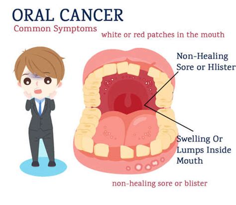 Oral Cancer Symptoms Warning Signs