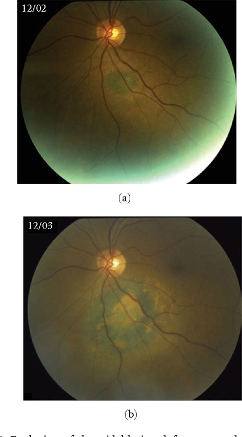 Figure 1 From Bilateral Diffuse Uveal Melanocytic Proliferation