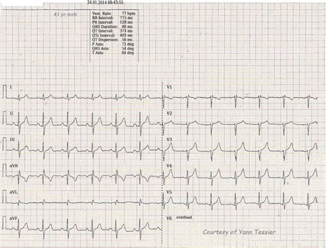 Ecg Teaching Series Atrial Flutter Ecg Guru Instructor Resources