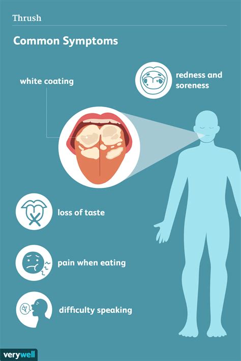 Thrush Signs Symptoms And Complications