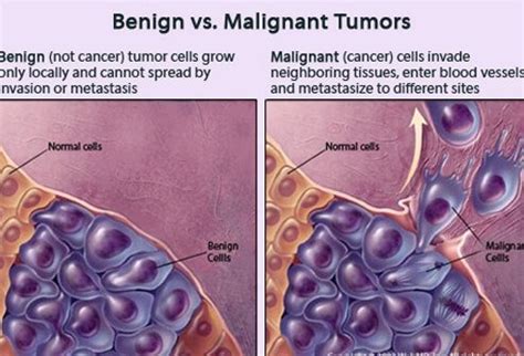 Science Tumors Benign Vs Malignant Diagram Quizlet