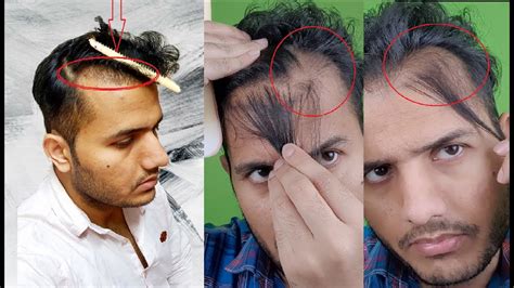 Hair Transplant Failure Aur Hair Transplant Failure Se Kaise Bache