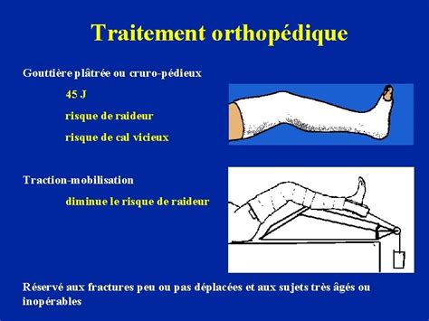 Fractures De Lextrmit Proximale Du Tibia Les Fractures