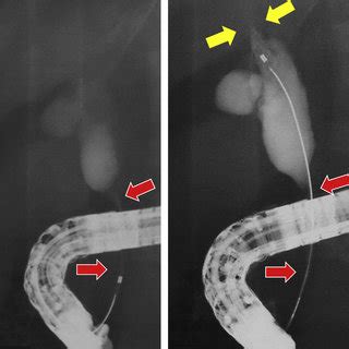 Endoscopic Retrograde Cholangiography Images Show Biliary Strictures At