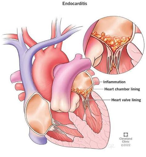 Endocarditis Treatment Medizzy