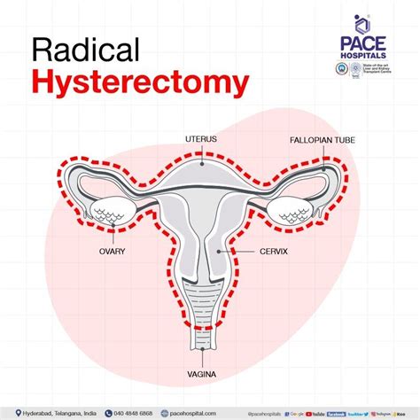 Hysterectomy Surgery In Hyderabad Indications Side Effects Cost