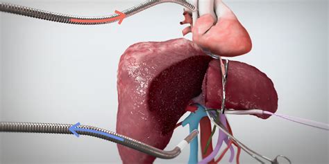 Extended Right Hepatectomy With Veno Veno Bypass Part I TVASurg