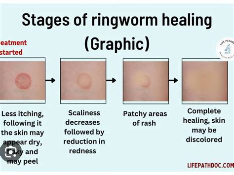 Rashes Eczema Or Ringworms 😰 Gallery Posted By Jojo Lemon8