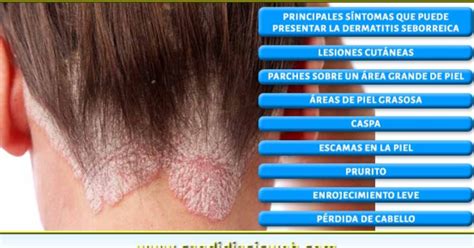 Remedios Naturales Contra La Dermatitis Seborreica