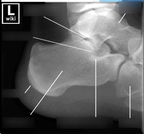 Calcaneus Labeling Diagram Quizlet