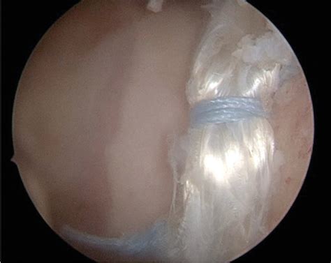 Figure From Comparison Of Acetabular Labral Reconstruction With Mm