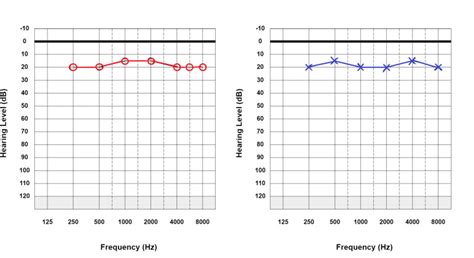 Figure Pure Tone Audiogram Showing Normal StatPearls NCBI