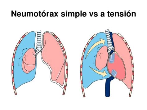 Enfermer En Urgencias Y Uci Neumotorax