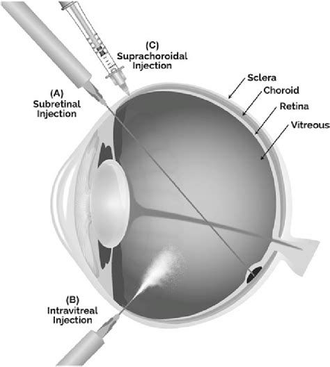 Routes Of Administration For Retinal Gene Delivery A Subretinal B