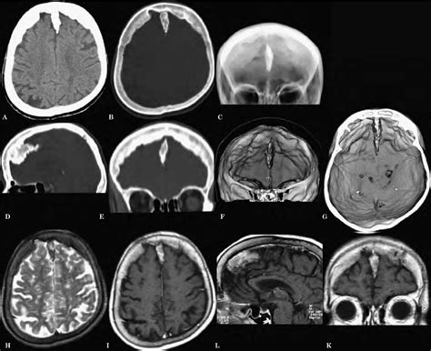 Falx Cerebri Ossification A B Axial Ct Scans With Soft Tissue And