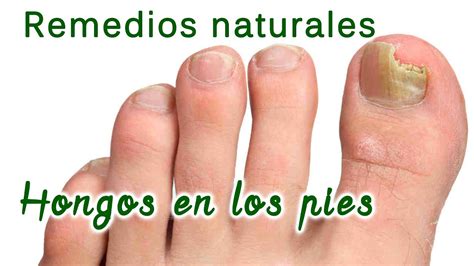 Hongos En Los Pies Y Manos Remedios Naturales Para Curarlos YouTube