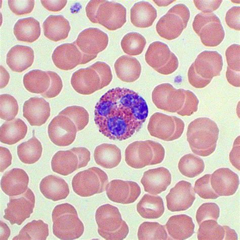 Medical Laboratory On X Test Eosinophil Count Absolute 43 Off