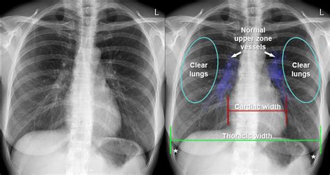 Normal Heart X Ray