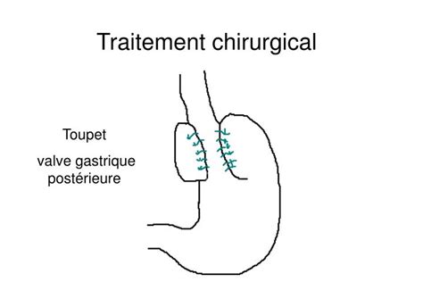 Ppt Reflux Gastro Oesophagien Hernie Hiatale Powerpoint Presentation