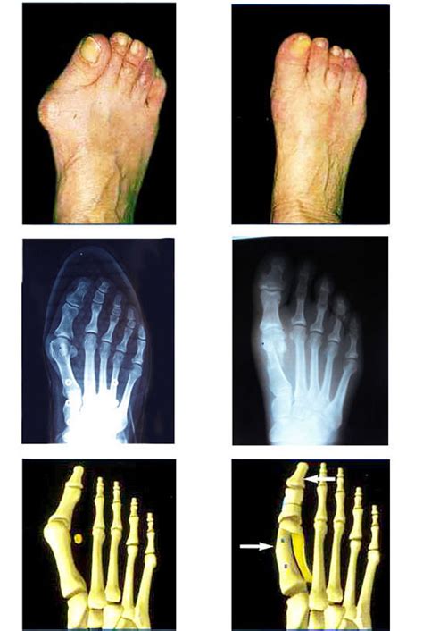 La Chirurgie Mini Invasive Clinique Du Pied