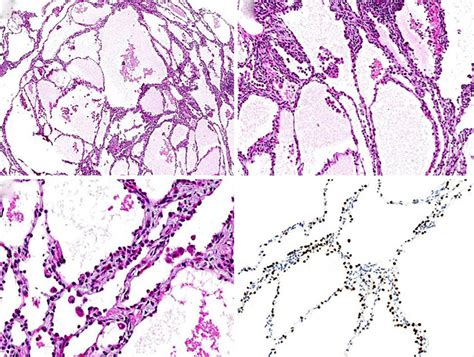 Hematoxylin And Eosin Stain Pathology Specimen Reveals A Multi Cystic