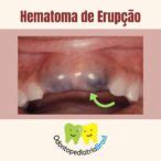 Hematoma De Erup O Odontopediatria Brasil