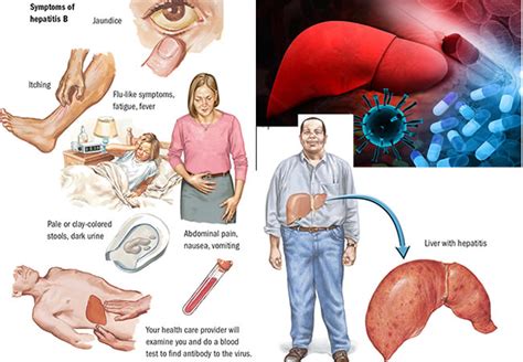 8 symptoms of hepatitis B you mustn’t ignore - Punch Newspapers