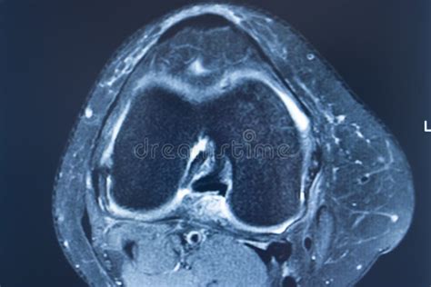 Knee injury mri mcl tear stock photo. Image of diagnosis - 172886114