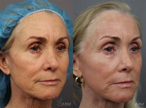 Laser Skin Resurfacing In San Diego La Jolla Cosmetic Laser Clinic