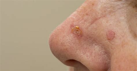 Actinic Keratosis The Precancerous Pathway To Squamous Cell Carcinoma