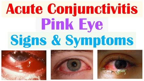 Subconjunctival Hemorrhage Blood In Eye Causes Treatment