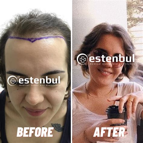 Female Hair Transplant In Turkey Estenbul Health