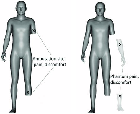 Phantom Limb Pain Prosthetics And 3D Printing Fabbaloo