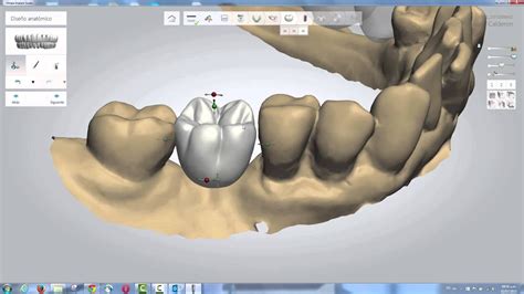 Implant Studio 3shape Webinar Youtube