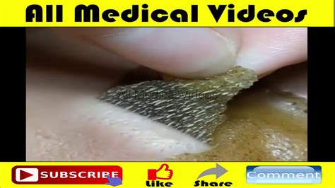 Pops Huge Cyst Like Pimple All Pimples Whitehead Blackhead Removal