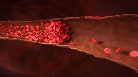 Deep Vein Thrombosis Vs Pulmonary Embolism Experts Share Key