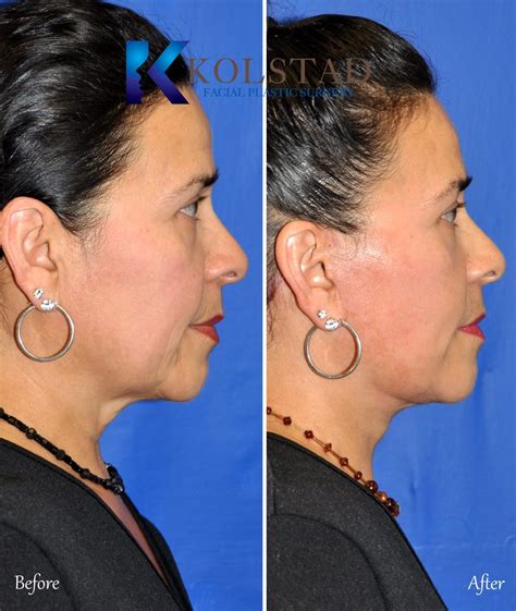 Facelift Before And After Gallery 18 Dr Kolstad San Diego Facial