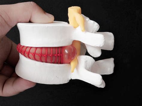 Human Lumbar Disc Herniation Model Demonstration Model Of Lumbar Hot