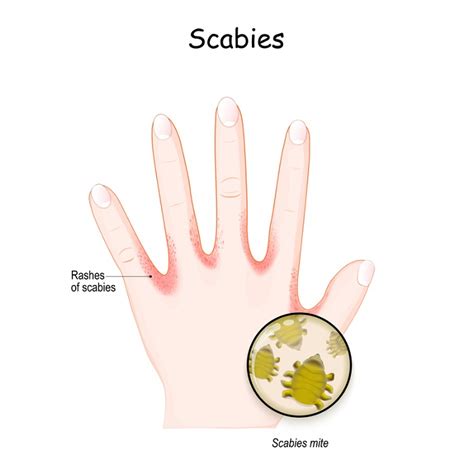 Scabies Life Cycle