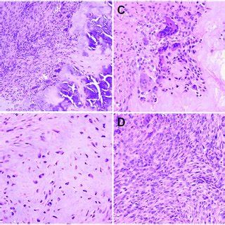 Histopathologic Findings Of Calcifying Aponeurotic Fibroma A The