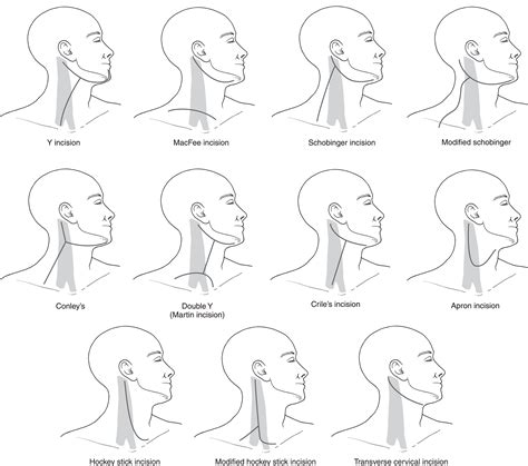 Levels Of The Neck And Classification Of Neck Dissection And Incisions