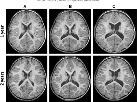 Figure 3 From Prenatal Isolated Mild Ventriculomegaly Is Associated