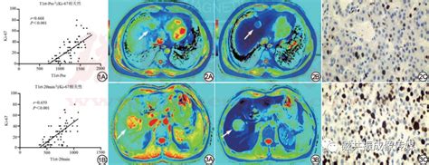 钆塞酸二钠增强mri T1 Mapping定量参数与肝细胞癌ki 67表达的相关性研究 哔哩哔哩